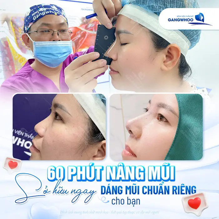 60 phút nâng mũi sở hữu ngay dáng mũi đẹp chuẩn cho bạn